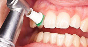 آیا جرم گیری دندان را سفید میکند؟