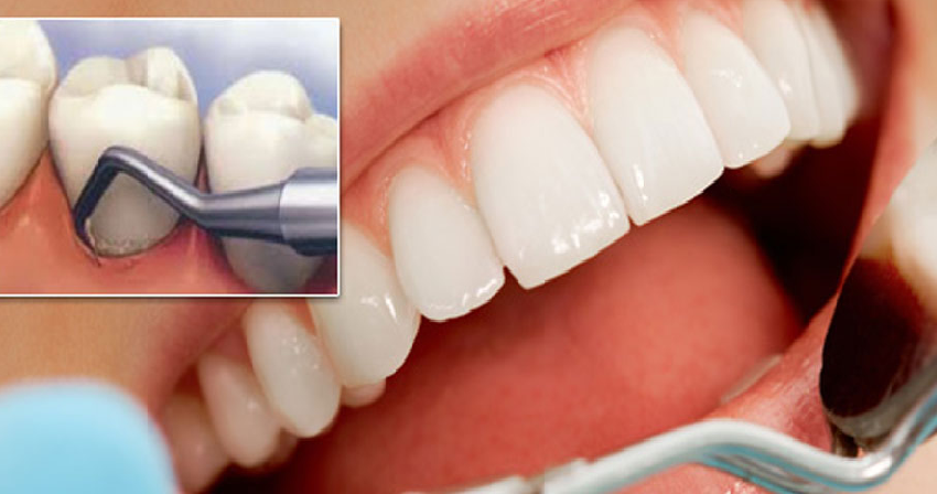 آیا جرم گیری دندان ضرر دارد؟