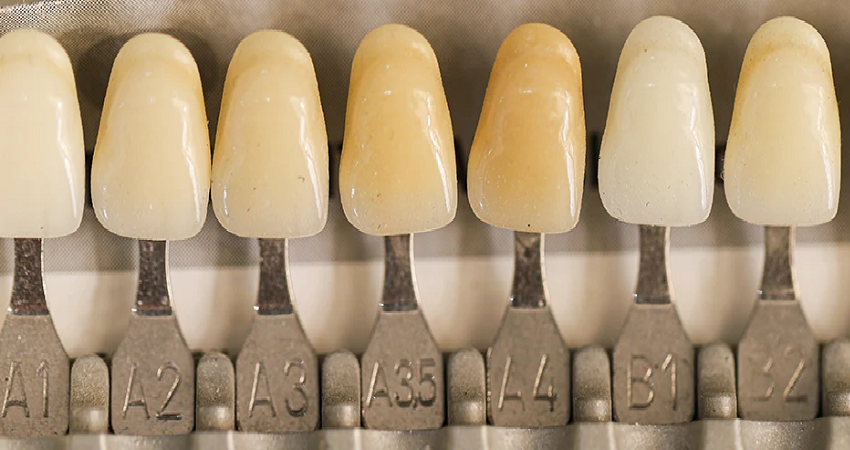 تغییر رنگ روکش دندان به چه عواملی بستگی دارد؟