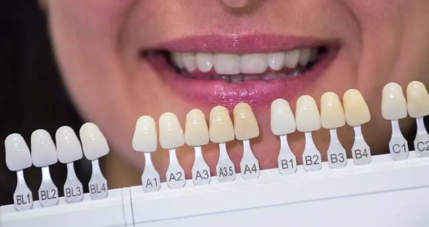 آیا میشود رنگ روکش دندان را تغییر داد؟