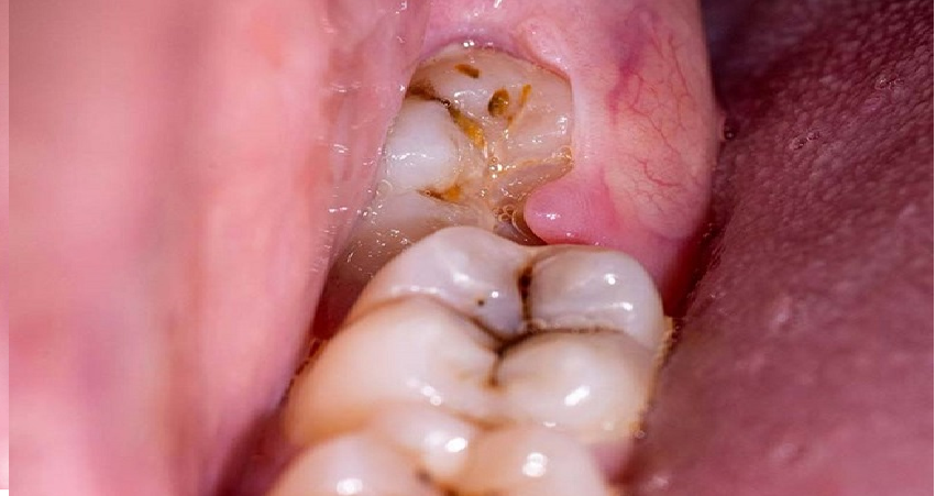 علت زود درآمدن دندان عقل