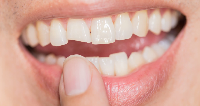 عوامل بروز آسیب به دندان­ های جلو