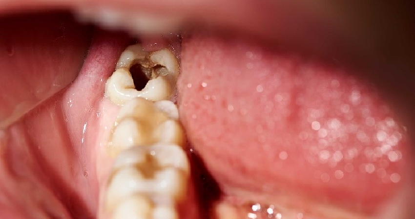 درمان کرم خوردگی دندان با طب سنتی  