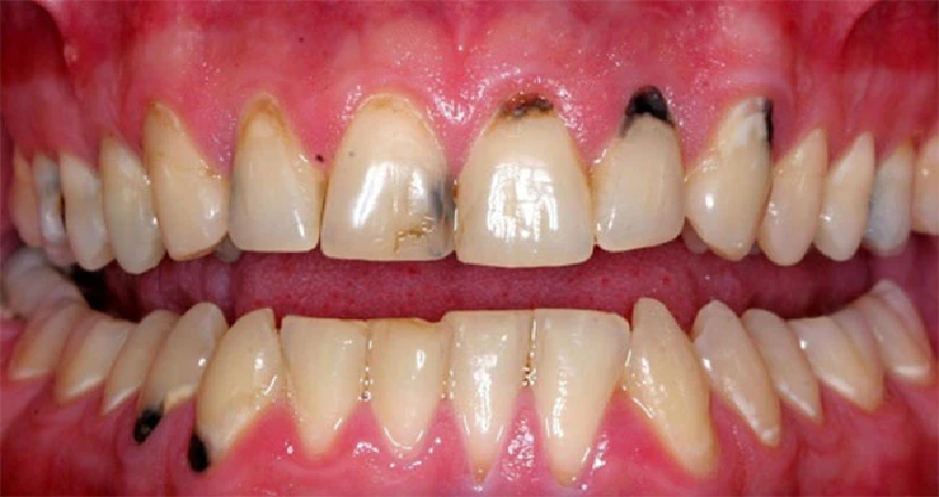 اقدامات لازم برای درمان سیاهی بین دندان ها