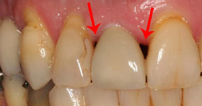 درمان خانگی سیاه شدن بین دو دندان
