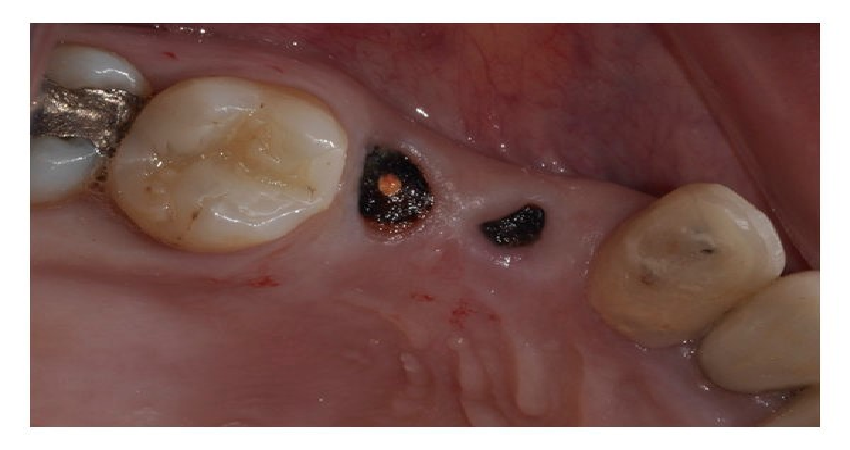 اگر دندان عقل در دهان باقی بماند چه اتفاقی می افتد؟