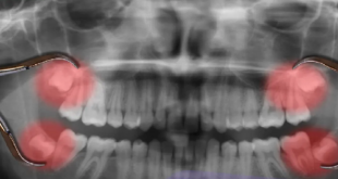 درآمدن دندان عقل چند روز طول میکشد