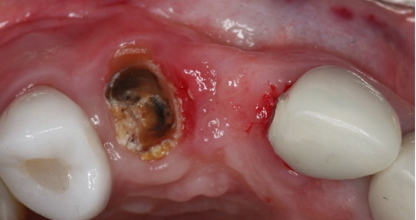 نشانه های عفونت بعد از جراحی و کشیدن دندان چیست؟