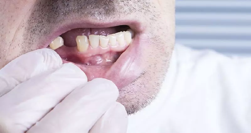 علائم ثانویه پس از جراحی دندان