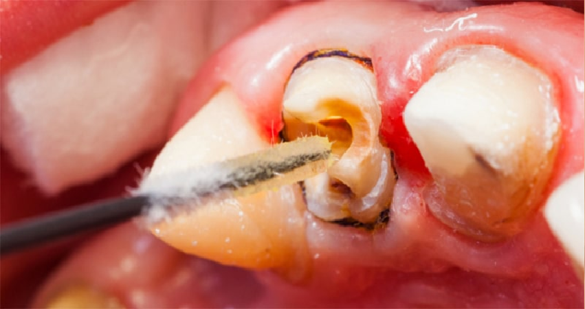 قرص برای درد دندان بعد از عصب کشی