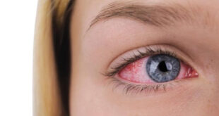 درمان خشکی چشم با گلاب
