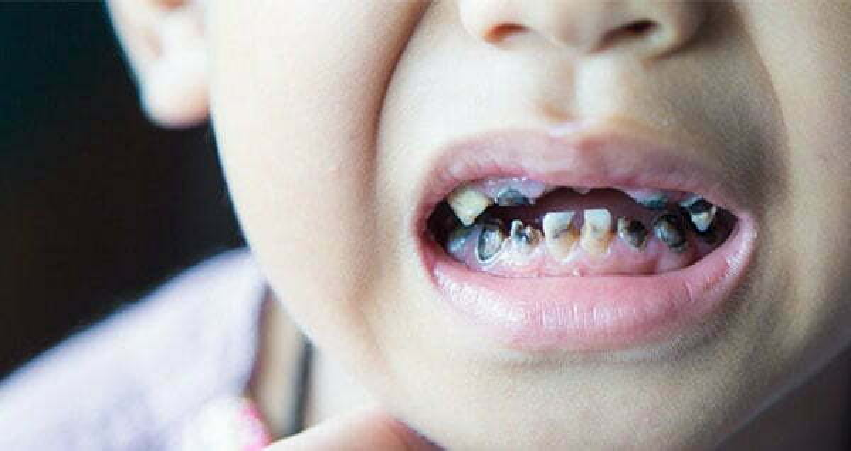 علت پوسیدگی دندانهای جلو در کودکان