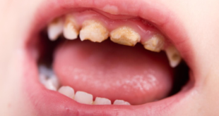 علت پوسیدگی دندانهای جلو در کودکان