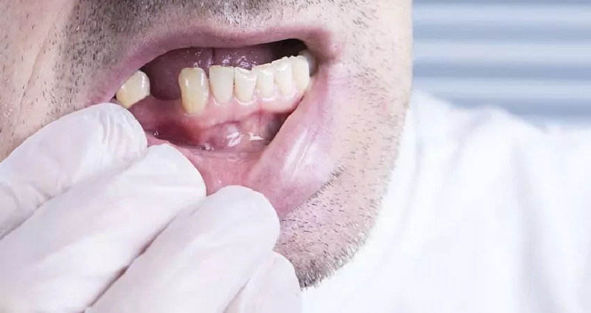 علت سفید شدن لثه بعد از کشیدن دندان