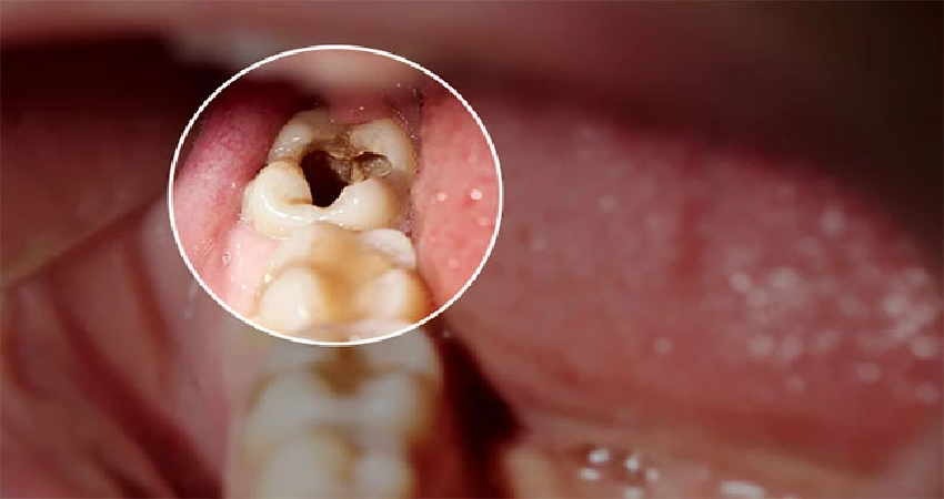 Round Root Wisdom Tooth ریشه دندان عقل | دانشنامه سیب