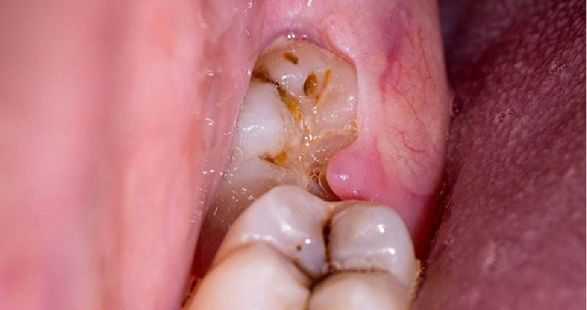 ریشه دندان عقل چند تاست؟