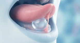 حباب زیر زبان چیست