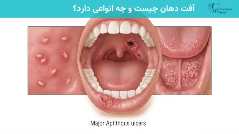 آفت دهان چیست و چه انواعی دارد؟